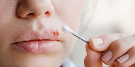 zoom sur des lèvres qui a de l'herpès