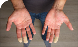 Syndrome de raynaud sur les mains